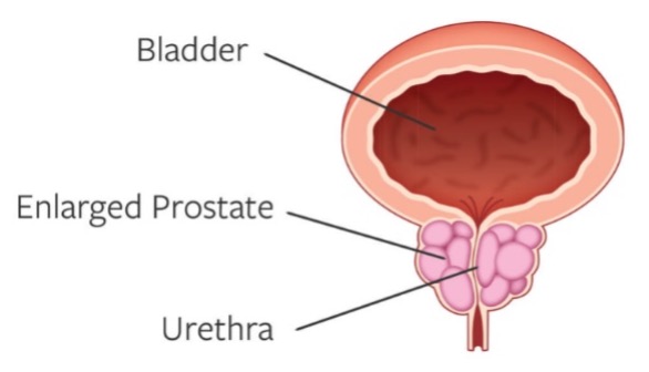 Enlarged Prostate