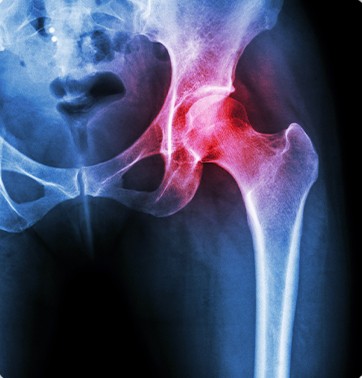 hip xray hip xray